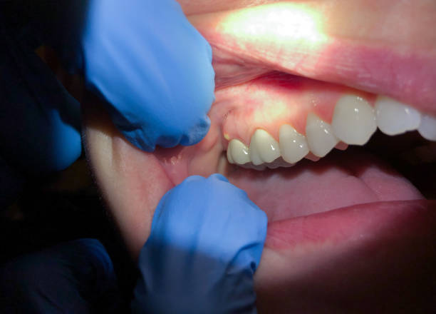 Best Emergency Wisdom Tooth Extraction in Swepsonville, NC